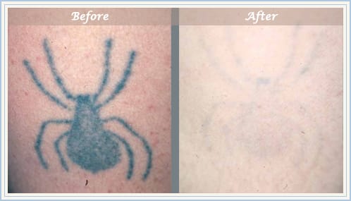 NYC Laser Tattoo Removal