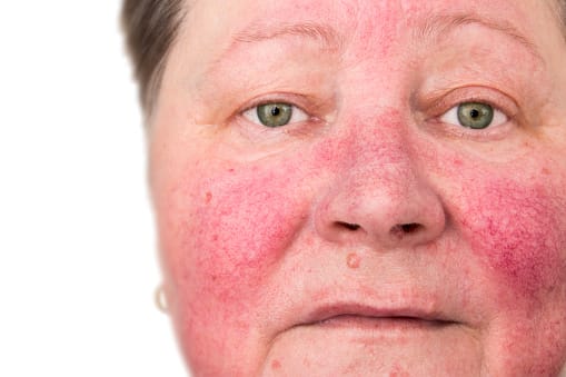 Rosacea Treatment in NYC