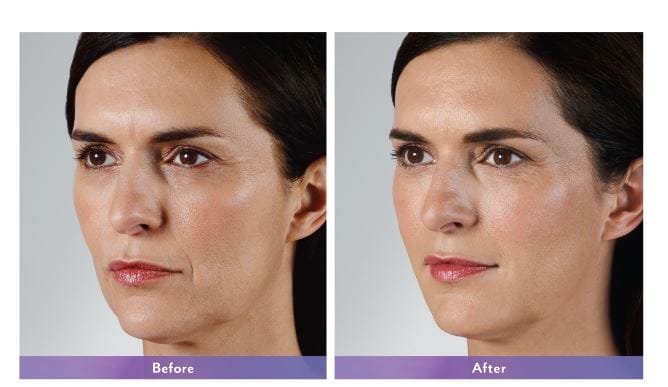 Juvederm Vollure XC NYC