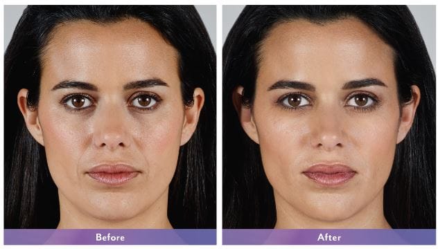 Juvederm Vollure XC NYC
