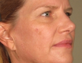 Before After Acne Treatment New Jersey Before and After | Skin Laser & Surgery Specialists of NY and NJ
