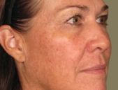 Before After Acne Treatment New Jersey Before and After | Skin Laser & Surgery Specialists of NY and NJ