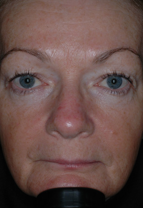 Before After Botox New Jersey Before and After | Skin Laser & Surgery Specialists of NY and NJ