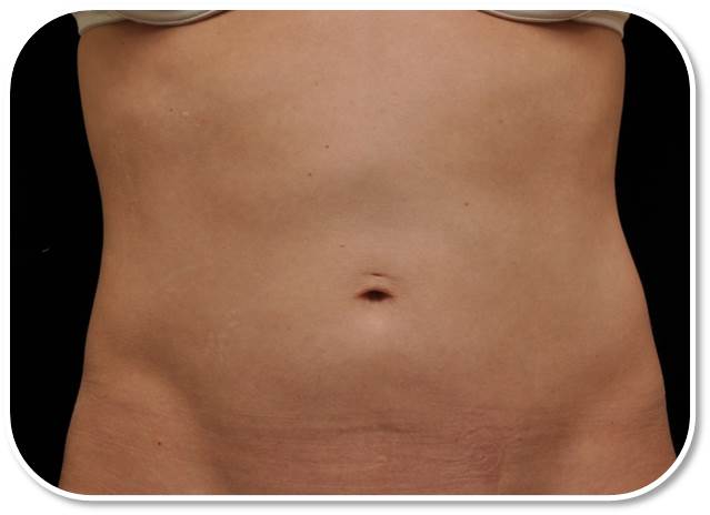 Before After Coolsculpting New Jersey Before and After | Skin Laser & Surgery Specialists of NY and NJ