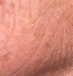 Before After Fraxel Laser Skin Resurfacing New Jersey Before and After | Skin Laser & Surgery Specialists of NY and NJ