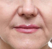 Before After Juvederm New Jersey Before and After | Skin Laser & Surgery Specialists of NY and NJ