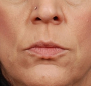 Before After Juvederm New Jersey Before and After | Skin Laser & Surgery Specialists of NY and NJ