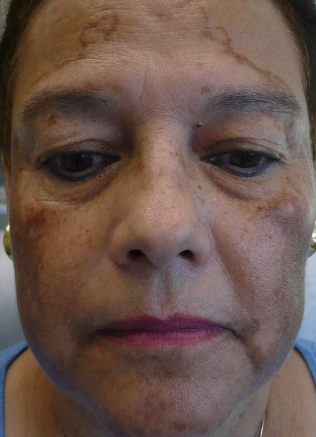 Before After Melasma Removal New Jersey Before and After | Skin Laser & Surgery Specialists of NY and NJ