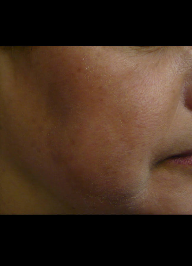 Before After Melasma Removal New Jersey Before and After | Skin Laser & Surgery Specialists of NY and NJ