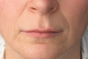 Before After Radiesse New Jersey Before and After | Skin Laser & Surgery Specialists of NY and NJ