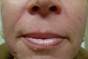 Before After Restylane New Jersey Before and After | Skin Laser & Surgery Specialists of NY and NJ