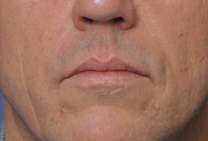 Before After Restylane New Jersey Before and After | Skin Laser & Surgery Specialists of NY and NJ