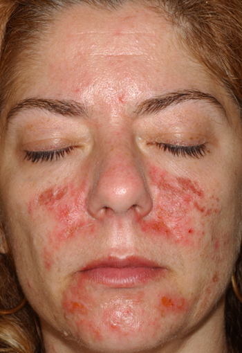Before After Rosacea Treatment New Jersey Before and After | Skin Laser & Surgery Specialists of NY and NJ