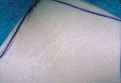 Before After Stretch Mark Removal New Jersey Before and After | Skin Laser & Surgery Specialists of NY and NJ